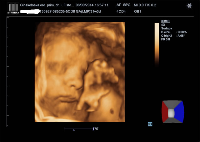 4D-ultrazvuk