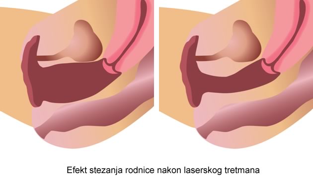 efekt-stezanja-rodnice